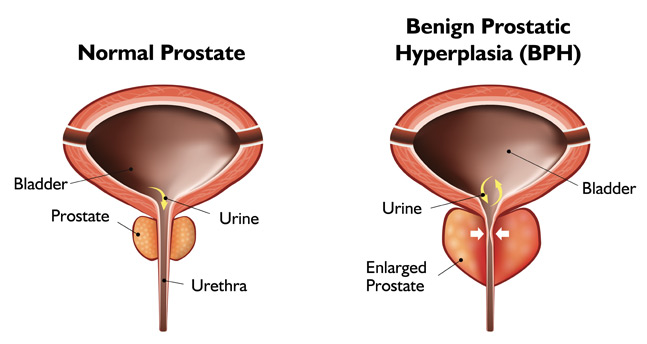 Normal Prostate vs Benign Enlargement Prostate